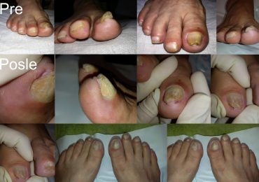 Urasli gljivični nokti kod dijabetičara - pre i posle
