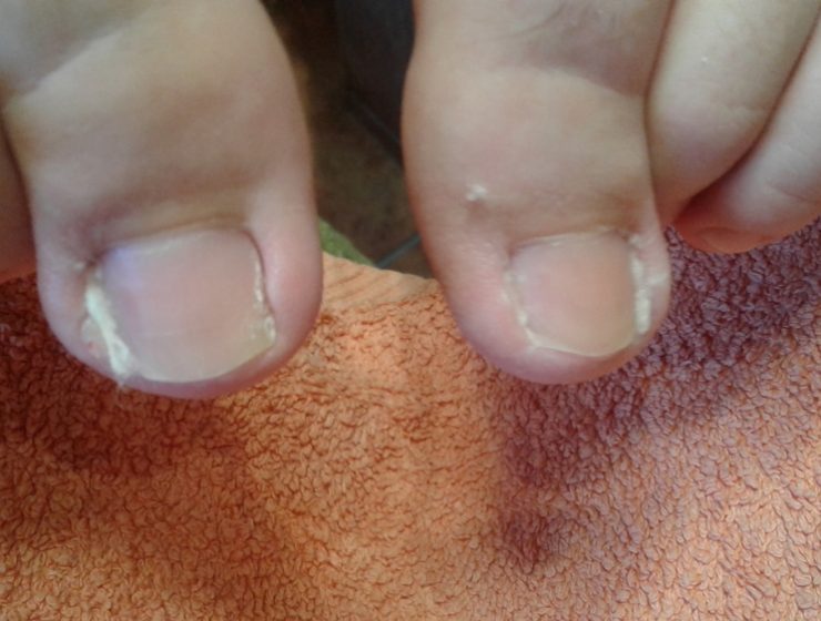 Urastanje noktiju kod dece