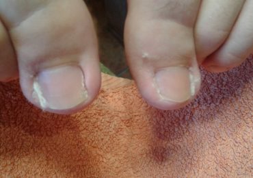 Urastanje noktiju kod dece - pre i posle